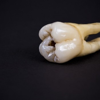 A tooth that fell out due to decay