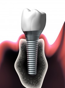 A sample of a dental implant