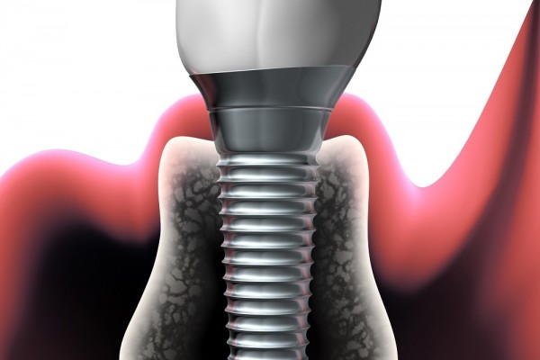 A sample of a dental implant