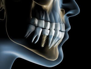 Dental Implant history